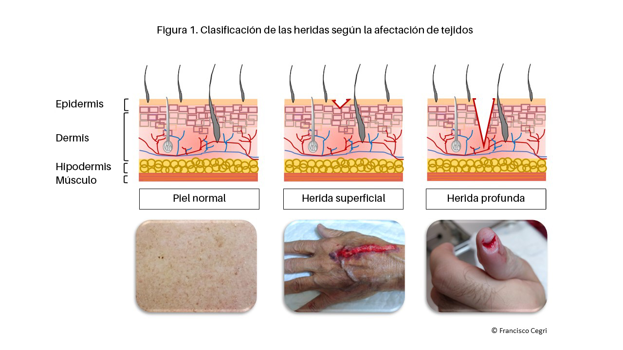 Infermeravirtual Heridas Y Quemaduras Problemas De Salud infermeravirtual-heridas-y-quemaduras-problemas-de-salud